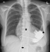 Aktuelles Bild - Abb. 1: Thorax-Röntgen