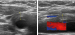 Abb. 2a-b: Sonographie bei TIPIC-Syndrom