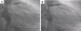 Abb. 4A-B: Buddy ballon technique