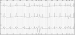 Abb. 1: Langzeit-EKG