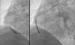 Abb. 4: RCA: Drug Eluting Balloons