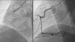 Abb. 5: RCA: Angioplastieergebnis