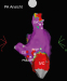 Abb. 2: Elektroanatomisches Voltage-Mapping