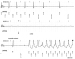 Abb. 3: AV-Block