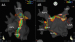 Abb. 4: Elektroanatomisches Mapping