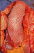 Abb. 5: Aortic-PEARS