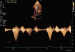 Abb. 2: Fall 1: LVOT-Gradient
