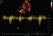 Abb. 5: Fall 3: LVOT-Gradient