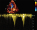 Aktuelles Bild - Abb. 10: Fall 4: LVOT-Gradient