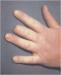 Abb. 2: Raynaud-Phänomen