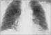 Abb. 7: Raynaud-Phänomen