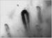 Aktuelles Bild - Abb. 11: Raynaud-Phänomen