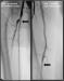 Aktuelles Bild - Abb. 2: Arteria femoralis superficialis - Stent