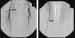 Abb. 3: Arteria femoralis superficialis - Stent