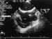 Fig. 2: Rechtsatrialer Appendix