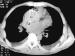 Fig. 3: Mediastinale Masse