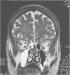 Abb. 1: Sinusitis