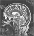 Abb. 4: Sinusitis frontalis