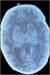 Abb. 8: Herpes simplex - Enzephalitis