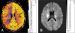Abb. 3A-B: Gehirn - Perfusion