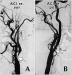 Abb. 2: Arteria carotis - Stenose - Stent