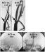 Abb. 3: Arteria carotis - Stenose - Stent