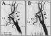 Abb. 4A-B: Arteria carotis - Stenose - Stent