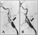 Abb. 5A-B: Arteria carotis - Stenose - Stent