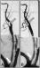 Abb. 6A-B: Arteria carotis - Stenose - Stent