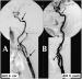 Abb. 7A-B: Arteria carotis - Stenose - Stent