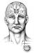 Abb. 1: Tiefe Hirnstimulation