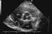 Abb. 1: Interatriales Septum - Aneurysma