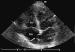 Abb. 2: Interatriales Septum - Aneurysma