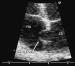 Aktuelles Bild - Abb. 3: Interatriales Septum - Aneurysma