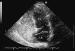 Abb. 4: Interatriales Septum - Aneurysma