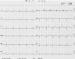Aktuelles Bild - Abb. 1: Sinusrhythmus mit zusätzlicher Vorhoferregung