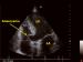 Abb. 1: Interventrikuläres Septum - Aneurysma