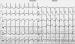 Abb. 6: Subakute Stentthrombose - Fallbericht