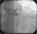 Abb. 7: Subakute Stentthrombose - Fallbericht