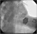 Abb. 8: Subakute Stentthrombose - Fallbericht