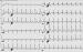Abb. 1: Paroxysmale Tachyarrhythmie