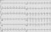 Abb. 3: Paroxysmale Tachyarrhythmie