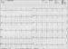 Abb. 3: EKG - Beschwerdefreiheit
