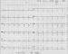 Abb. 4: EKG - Sinusrhythmus
