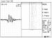 Abb. 5: Einzelfaserelektromyographie - ALS