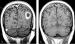 Abb. 4a-b: Hirnmetastase - Planungs-MRT für Gamma Knife