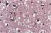 Abb. 1: Spongiforme Enzephalopathie