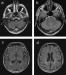 Aktuelles Bild - Abb. 1a-d: Primäre Lateralsklerose - Degeneration - Marklagerdefekte