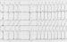 Aktuelles Bild - Abb. 1: DDD-Schrittmacher-EKG