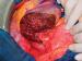 Abb. 6: Lebertransplantation - Spenderoperation